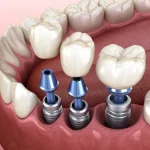 Implanty zębowe Szczecin